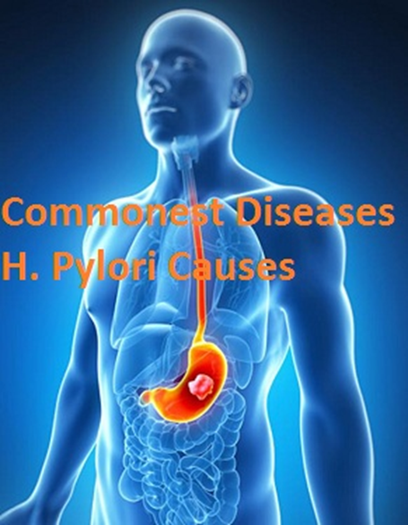 H. Pylori and Your Stomach: Symptoms, Treatment & Care