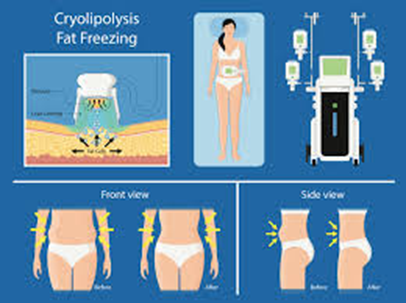 Cryolipolysis: The Chill Pill for Stubborn Fat