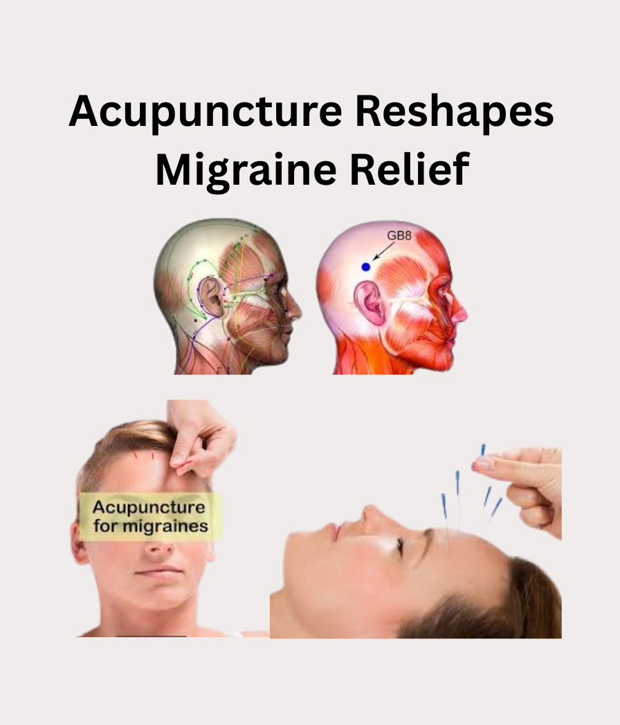The Mind-Body Link: Acupuncture Reshapes Migraine Relief