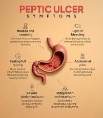 peptic ulcer symptoms 