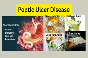 Peptic Ulcer Disease: Symptoms, Causes, Treatment & Natural Remedies