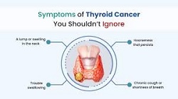 Thyroid Cancer Symptoms
