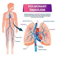 What is a pulmonary embolism?