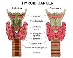 Understanding Thyroid Cancer