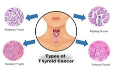 Type of thyroid cancer